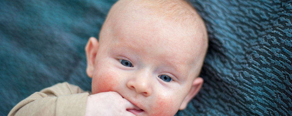 Baby Food Allergies, Causes, Symptoms, and Remedies